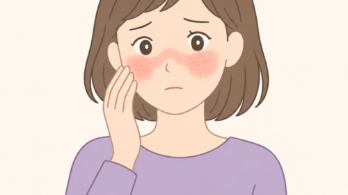 蝶形紅斑