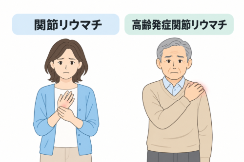 関節リウマチと高齢発症関節リウマチ
